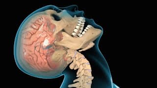 What is Traumatic Brain Injury?